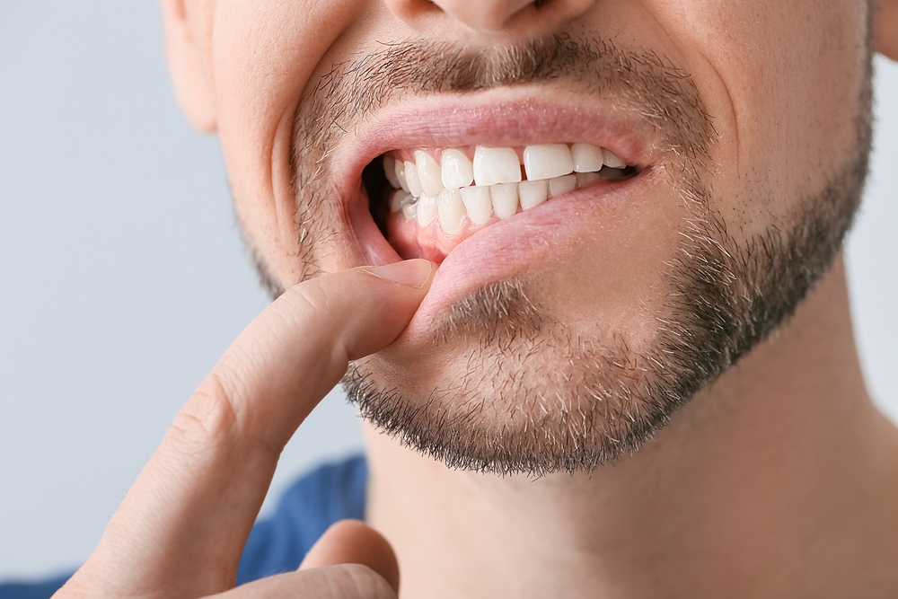 Gingivectomy