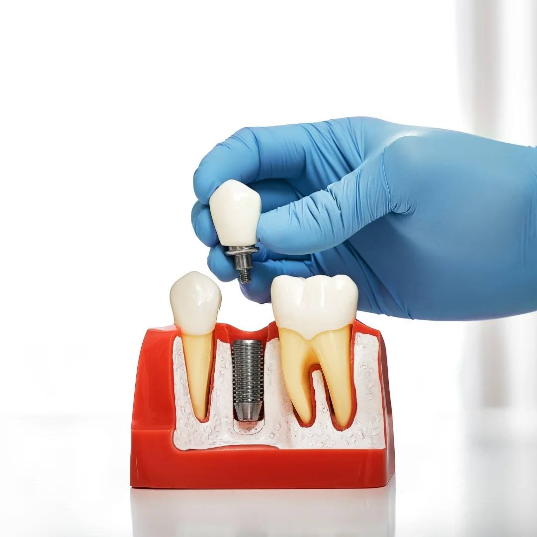 implant dentistry in Strathroy, ON