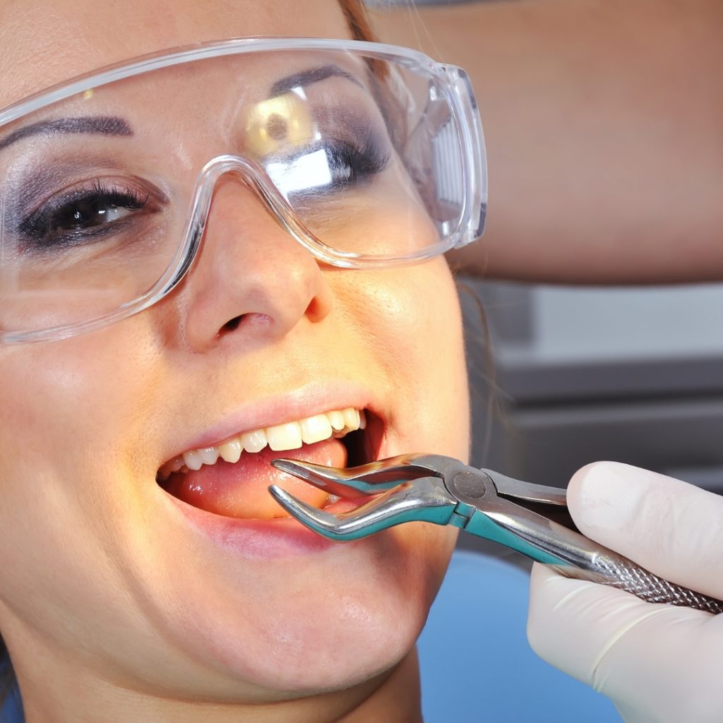 Tooth Extractions