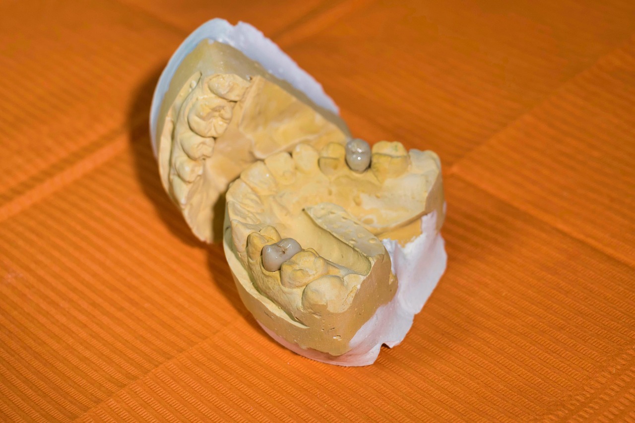 Dental lab model showing crowned teeth restorations on a prepared mouth cast
